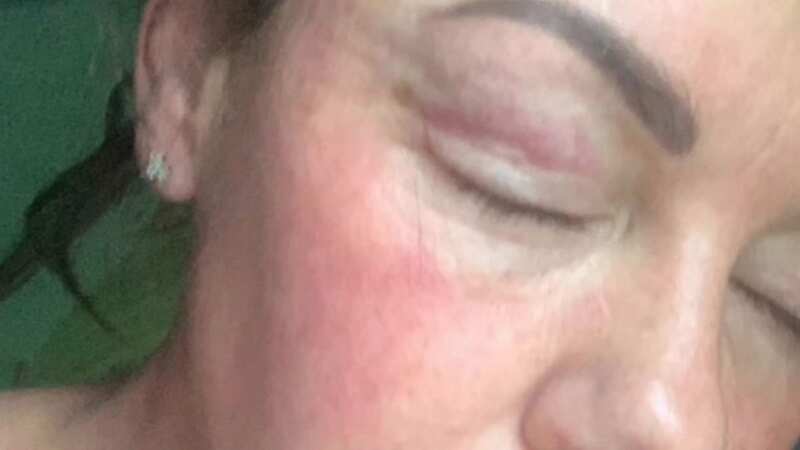 Michelle Heaton shares shocking pictures from her battle with alcohol addiction