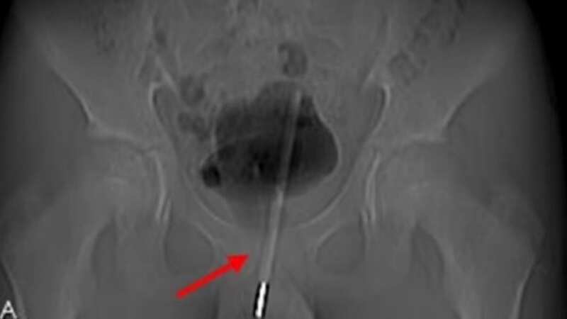 The thermometer had to be removed with keyhole surgery because doctors feared removing it through the urethra could damage him further (Image: Supplied)