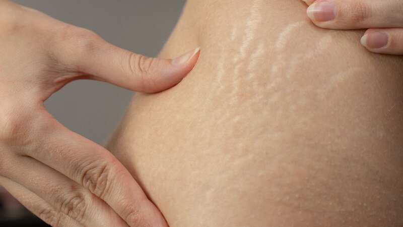 This £2.99 cream from Aldi helps reduce the appearance of stretch marks (Image: Getty Images/iStockphoto)