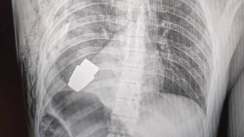 An X-ray showing the grenade inside the soldier