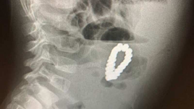 Doctors think the youngster swallowed the beads separately before they stuck together inside his body (Image: Jam Press)