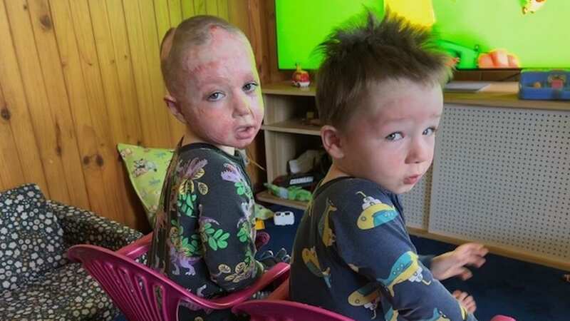Xander and Tanner survived but suffered scars and burns (Image: Jam Press)