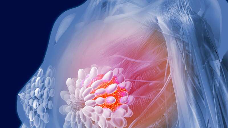 Learning to read the signs of breast cancer (Image: Getty Images)