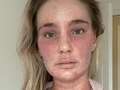 Woman no longer recognises herself after eczema cream 'burns' skin all over body qhxidiqxkiqxeinv