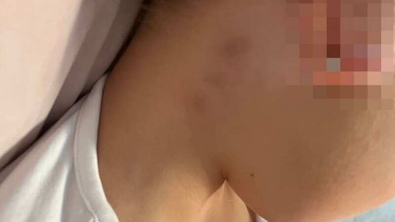 The worried parent shared images of bruises the child sustained after being strangled at school