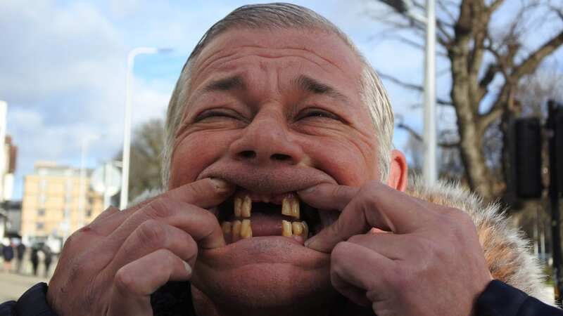 Richard was left with nothing after the brutal attack that saw his four front teeth fall out (Image: Sussex News and Pictures)
