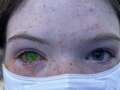 Insect blamed for mystery rise in life-changing illness that alters eye colour