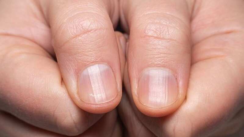 Finger clubbing could be an early sign of lung cancer