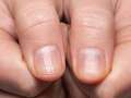 Finger clubbing could be an early sign of lung cancer