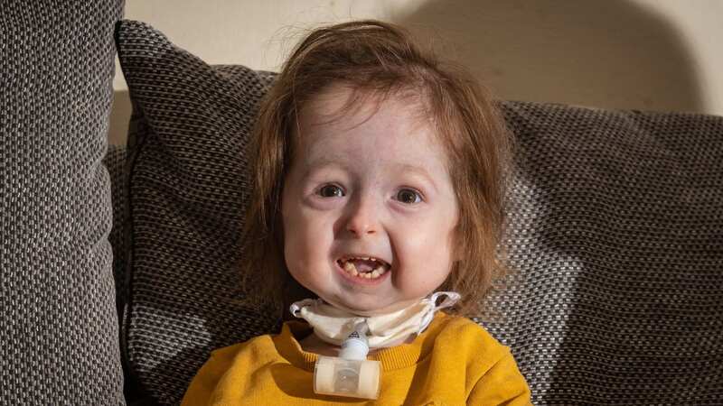 Isla Kilpatrick-Screaton suffers from a strand of mandibuloacral dysplasia (Image: Adam Hughes / SWNS)