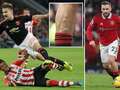 Story of Luke Shaw's leg scar as he bids to complete Man Utd's greatest comeback eiqehiqqeituinv