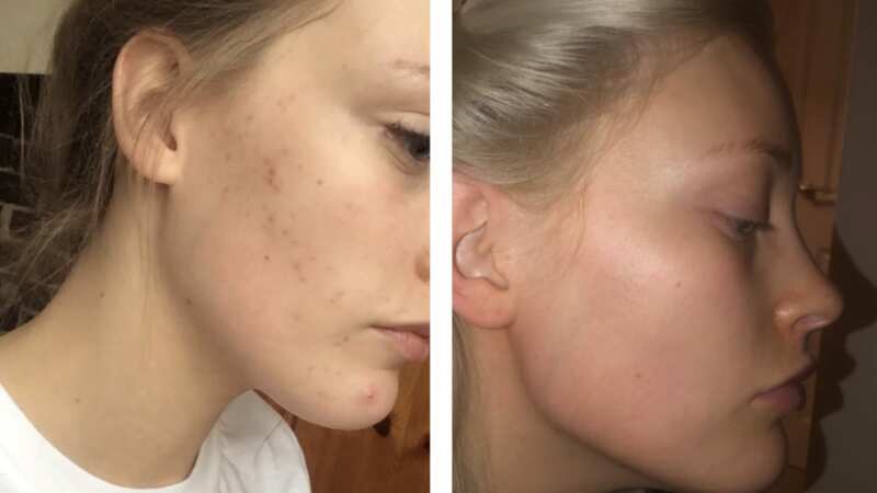 Skin is notably clearer after using (Image: Nip+Fab)