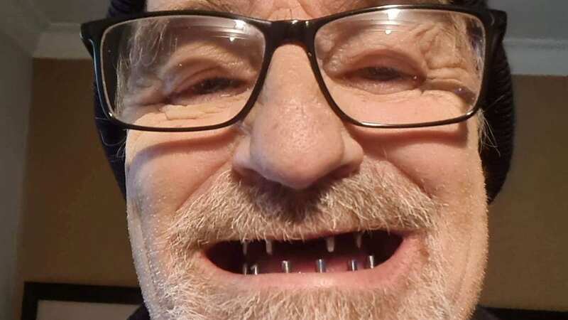 Paul Pilkington shows off his new smile (Image: Courtesy Paul Pilkington / SWNS)
