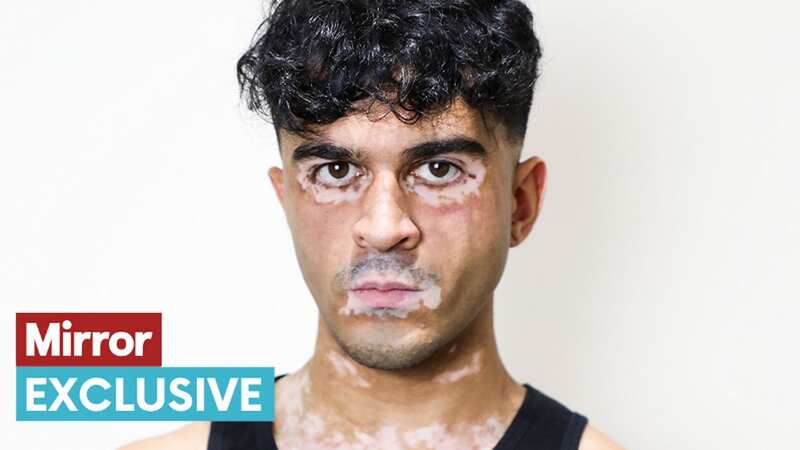 Sultan now sees his vitiligo as his 