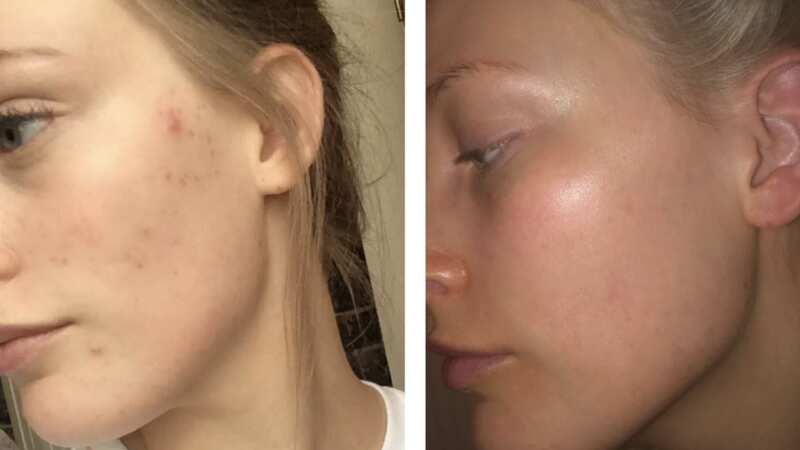 Skin is clearer after using the mask (Image: Nip+Fab)