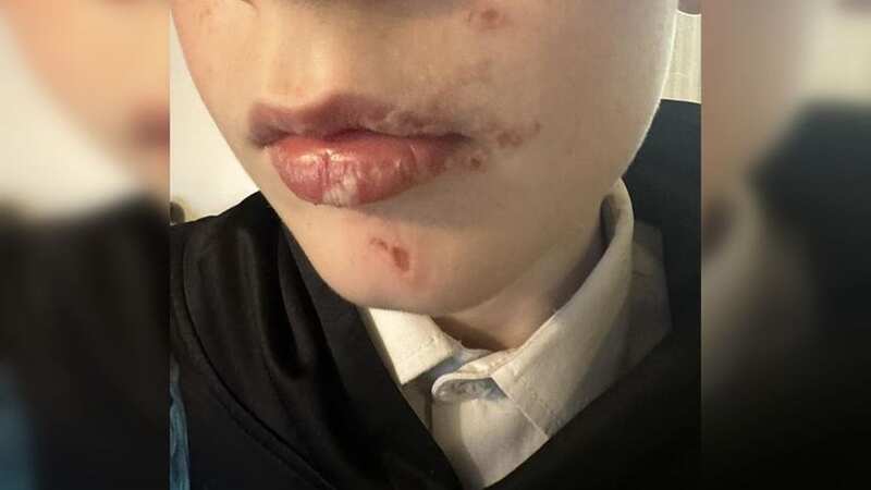 Ethan Warburton, 11, was left with cuts and burns following an unprovoked assault that knocked him unconscious (Image: Liverpool Echo)