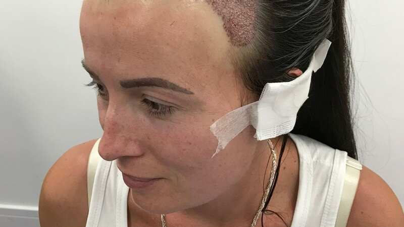 Billie Foyle has her confidence back after getting a hair transplant (Image: Kennedy News and Media)