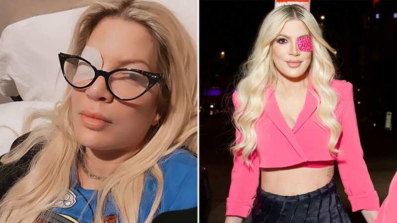 Tori Spelling gets eye ulcer after keeping contact lenses in for days