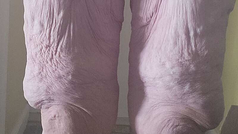 Folds of loose skin are causing a woman who lost 11st agony (Image: Kennedy News and Media)