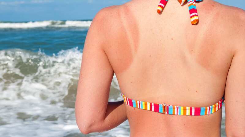 Soaking up the sunshine could lead to sun poisoning (Image: Getty Images)