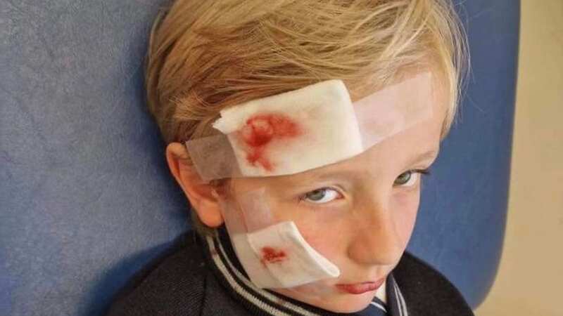 Mitchell Neville, 7, is waiting to find out if he needs plastic surgery (Image: DogsLive)
