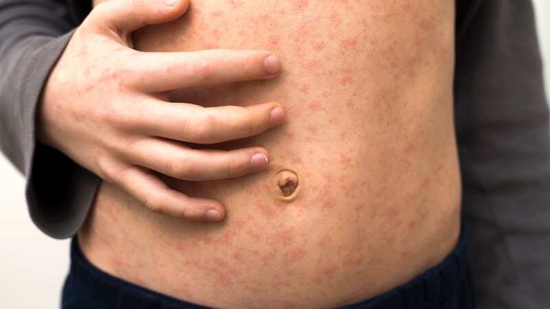 Sick child with red rash spots from measles (stock image) (Image: Getty Images/iStockphoto)
