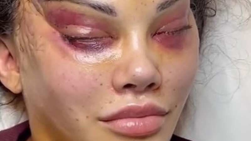 Influencer deforms face after invasive surgery to give herself 