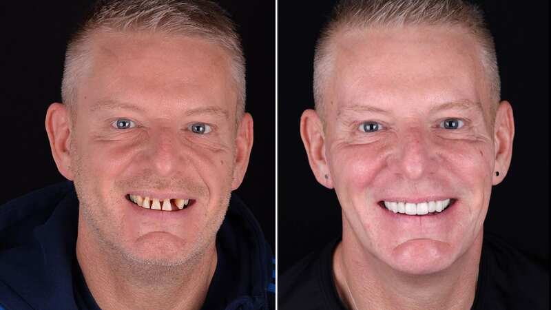Salford landlord Gavin Reid’s teeth had long plagued his smile (Image: Rüh Dental)