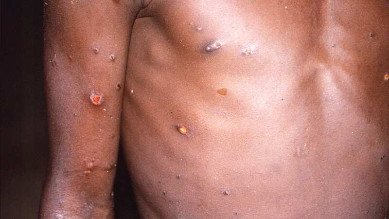 Experts warn people to look out for monkeypox symptoms as it has not been eradicated (Image: PA)