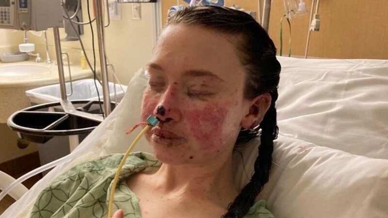 The burn-like symptoms clearly visible on Kayla