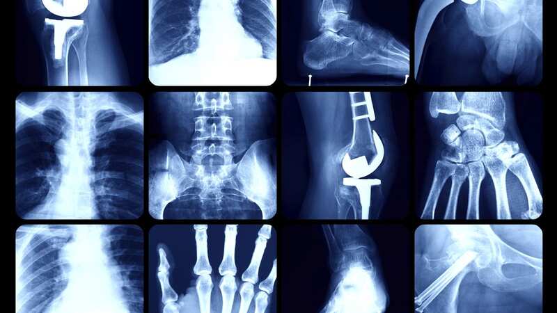 The health of your bones could play a part in your life expectancy. (Image: Getty Images)