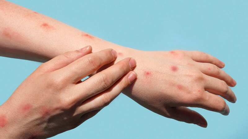 Mpox can be passed on from person to person through contact (Image: Getty Images/iStockphoto)