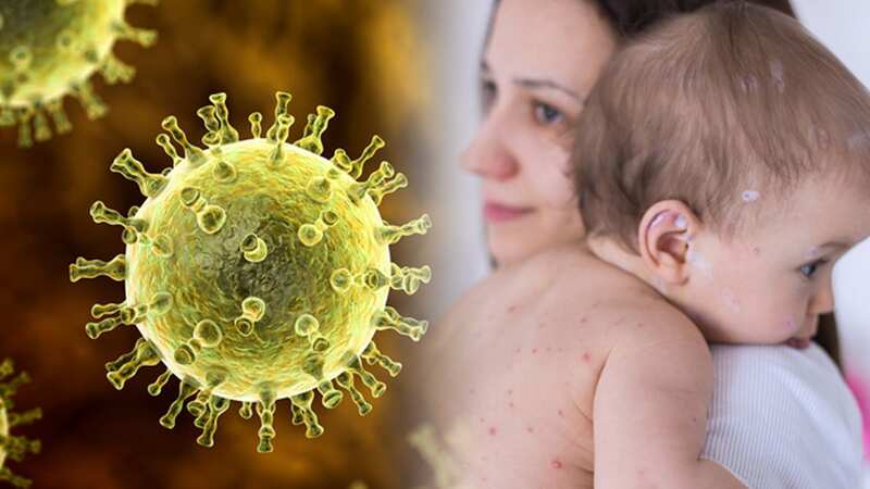 There are a lot of commonly held beliefs about chickenpox that simply aren