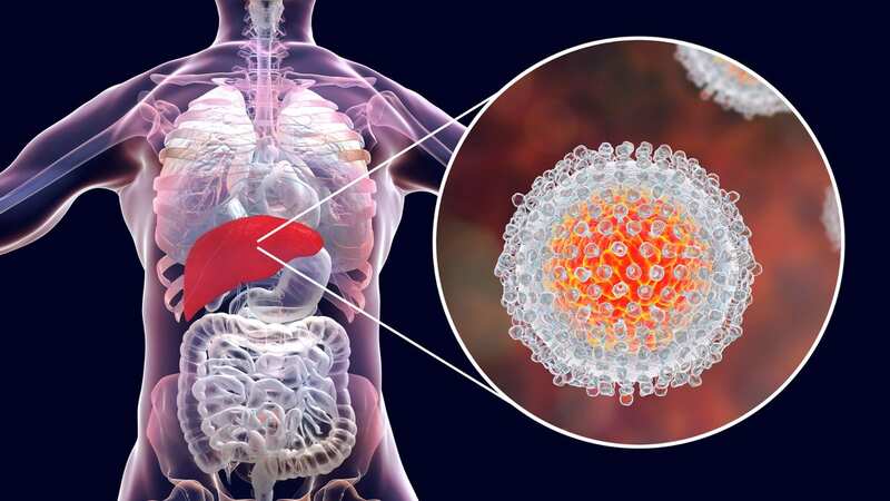 Hepatitis C usually displays no symptoms until the virus causes enough damage to bring on liver disease. (Image: Getty Images/Science Photo Libra)