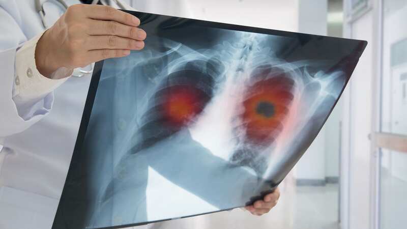 Taking the drug osimertinib after surgery dramatically reduced the risk of dying by 51% (file photo) (Image: Getty Images/iStockphoto)