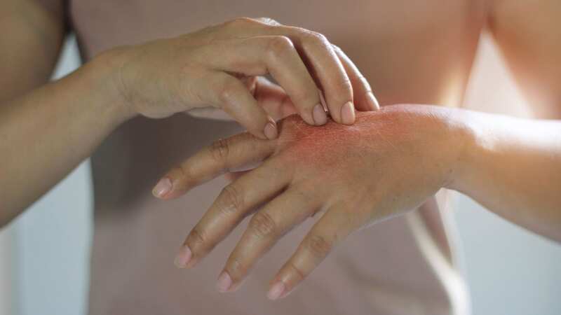 Syphilis can cause rashes on the palms of the hands (Image: Getty Images/iStockphoto)