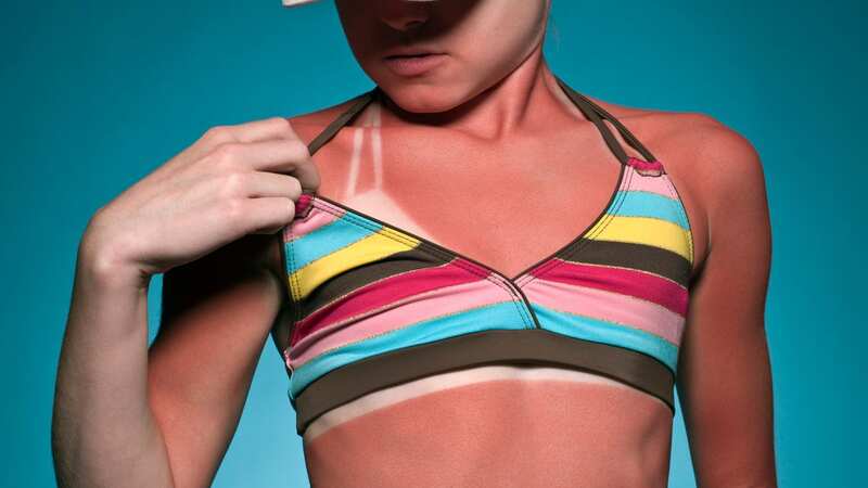 If you have sunburn, your skin may be painful and hot (Stock photo) (Image: Getty Images)