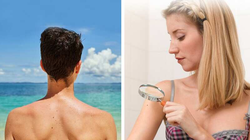 Around 86 per cent of melanoma skin cancer cases are preventable. (Image: GettyImages)