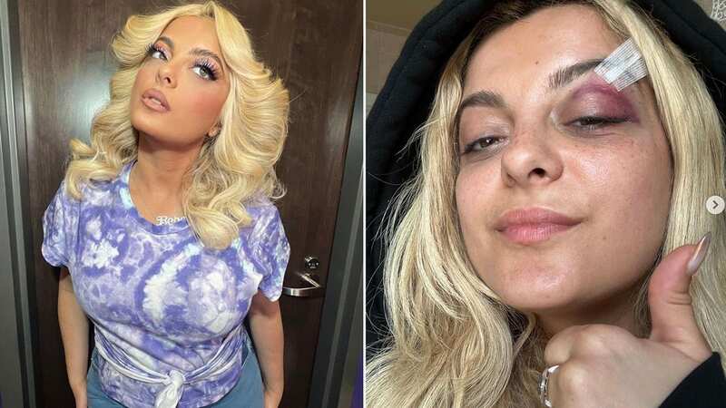 Bebe Rexha shares snaps of gruesome injury after being hit in the face with a phone (Image: Instagram)