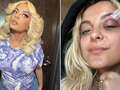 Bebe Rexha shares snaps of injury after being hit in the face with a phone qhidqxixiqzzinv