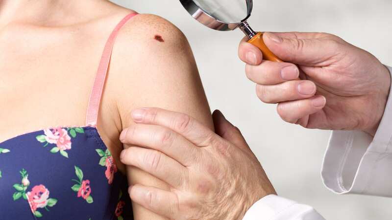 5 skin cancer red flags everyone must know and how to spot them before too late