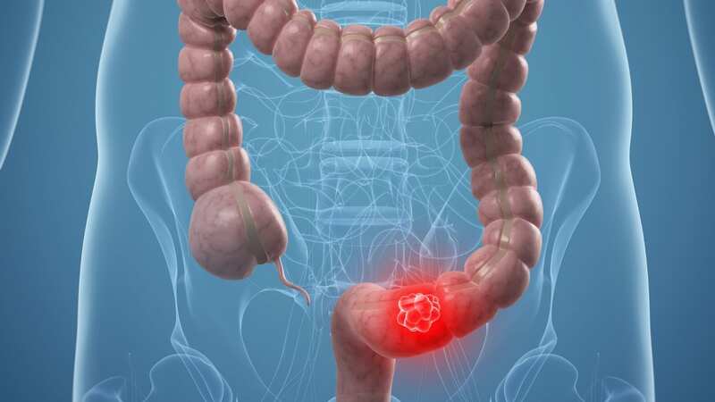 Early detection of bowel cancer is important (Image: Getty Images/Science Photo Library RF)