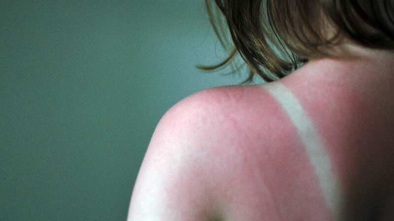 Sunburn can be itchy and uncomfortable (stock photo) (Image: Getty)