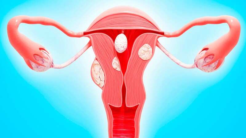 Uterine cancer cases are on the rise — and so too are potential deaths from them (Image: Getty Images/Science Photo Library RF)