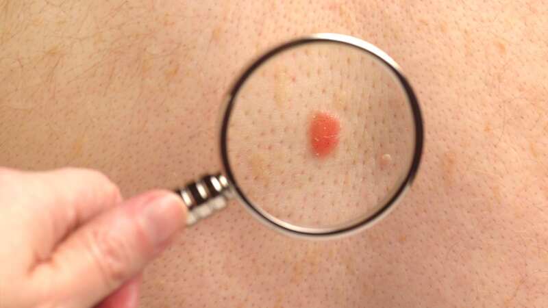 Skin cancer cases are rising (Image: Getty Images)