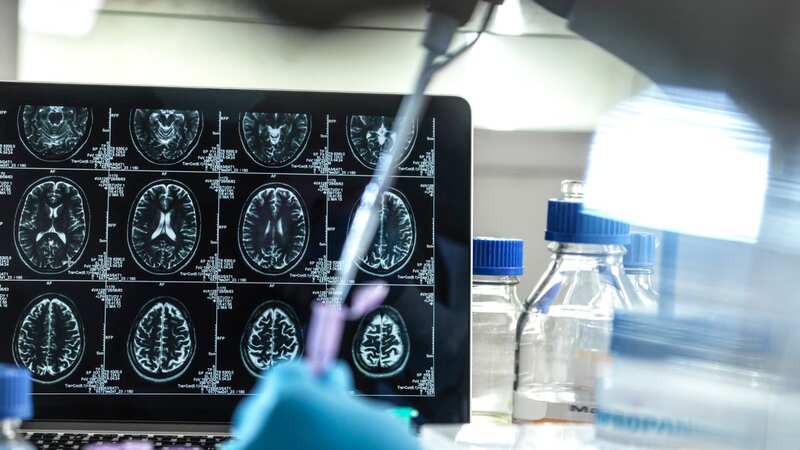 In the US one in three seniors die with Alzheimer
