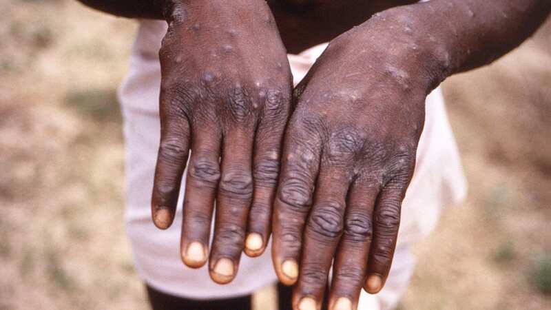 Monkeypox symptoms usually progresses to developing a rash, sores, or spots (Image: Centers for Disease Control and)