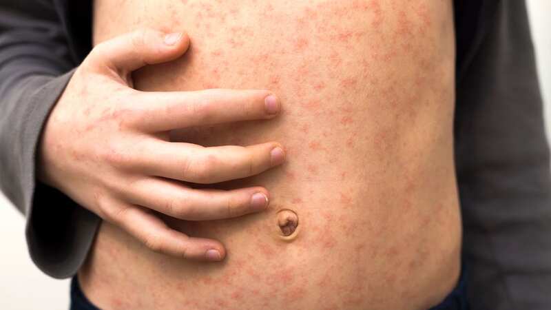 London could see as many as 160,000 measles cases according to modelling (stock image) (Image: Getty Images/iStockphoto)