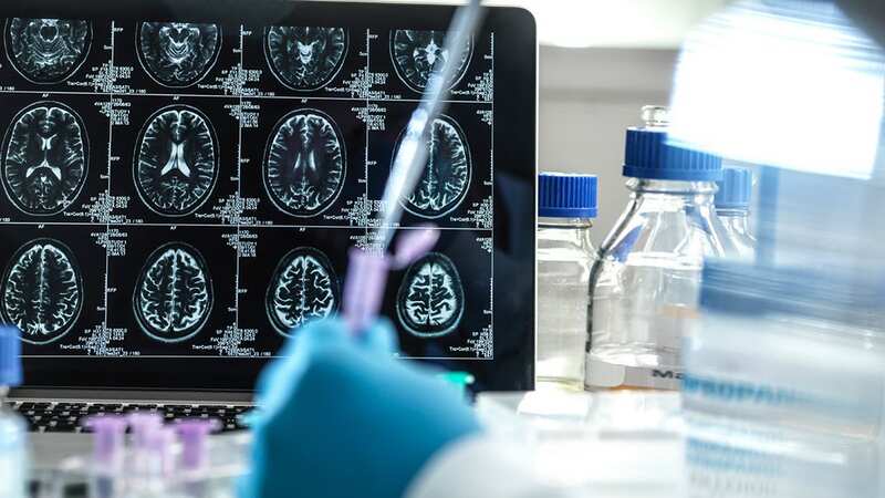 The landmark findings appear to confirm that Alzheimer