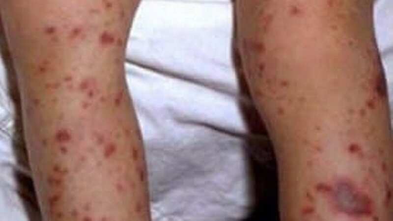 A man has been diagnosed as the first person to die from meningococcal in South Australia this year (Image: doctorsofsouthmelbourne.com)